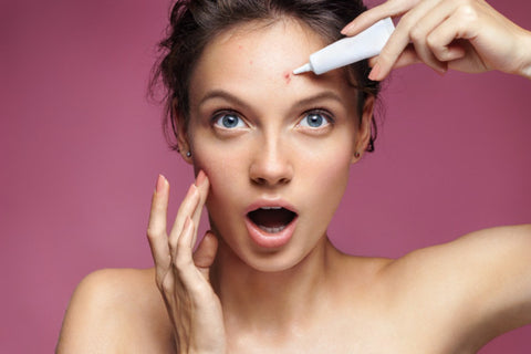 Rimedio naturale per l’acne giovanile