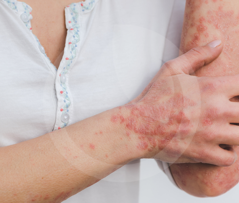 AHCC e psoriasi: come supporta il sistema immunitario nelle malattie infiammatorie