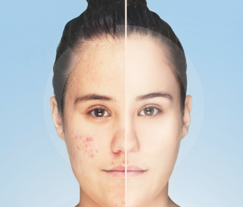 Acne: cause, tipologie e trattamento con NURE Skin Balance