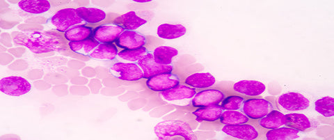 Paziente sottoposto a terapia supportiva per leucemia mieloide acuta