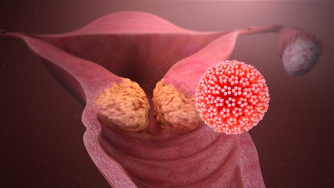 Prevenzione del cancro al collo dell'utero con AHCC e supporto al sistema immunitario